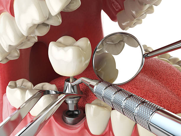 Best Emergency Dentist for Lost Fillings or Crowns in Anton, TX
